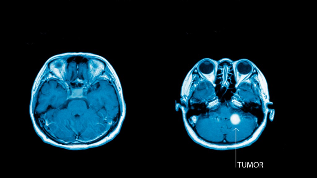 El gadolinio, clave para detectar tumores cerebrales, podría ser tóxico