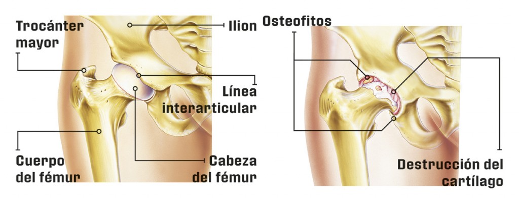 Cómo actúa la artrosis 2