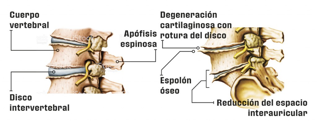 Cómo actúa la artrosis 3