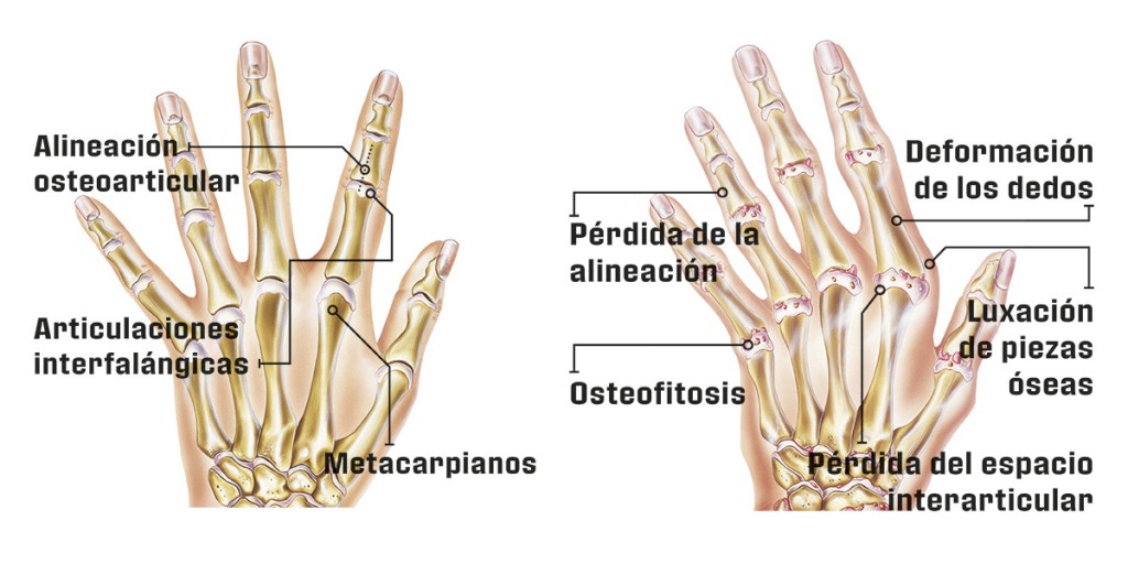 Cómo actúa la artrosis 4